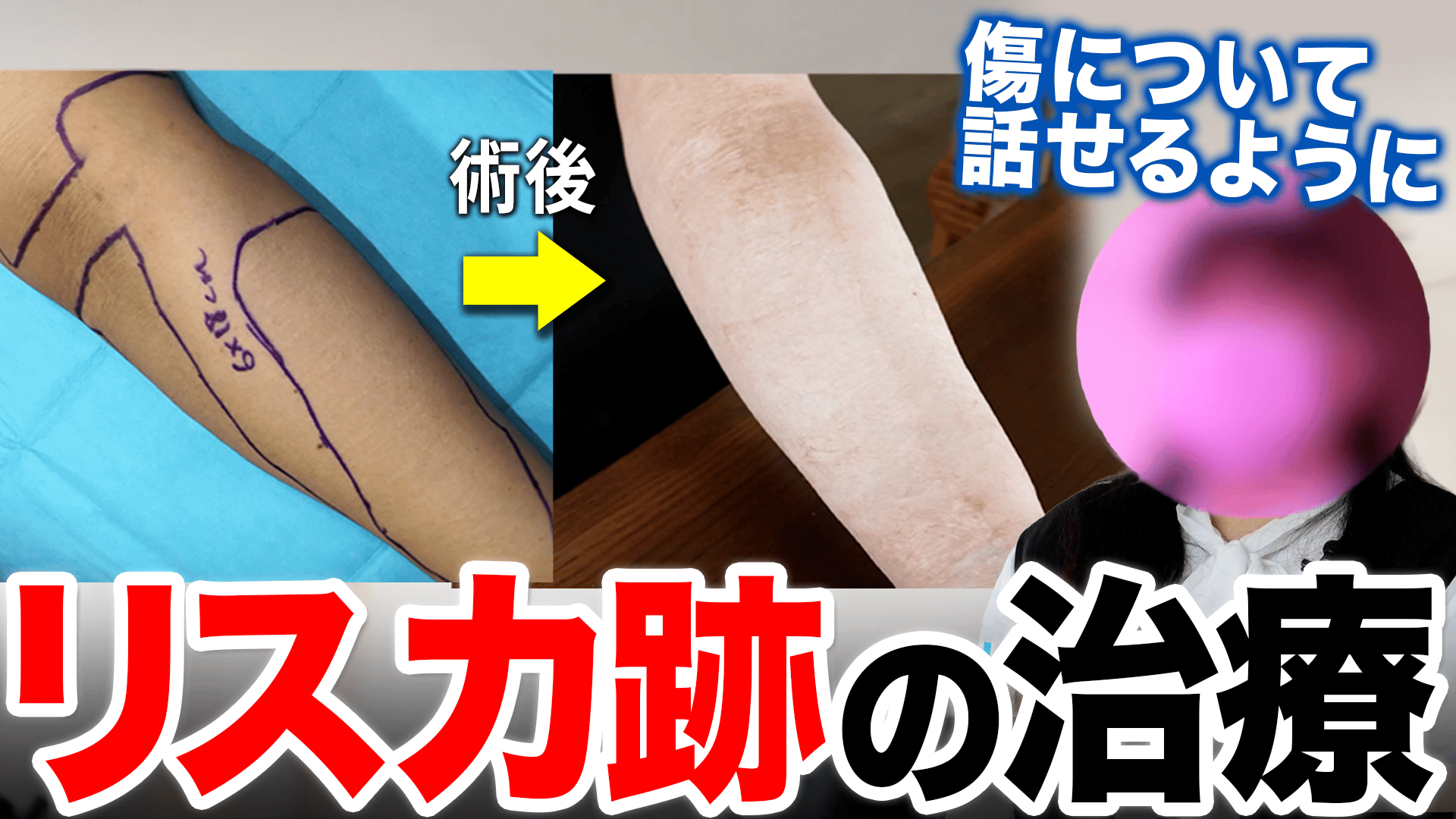 リスカ跡を手術で“横”に...傷の変化は心を癒す?当事者の苦悩 