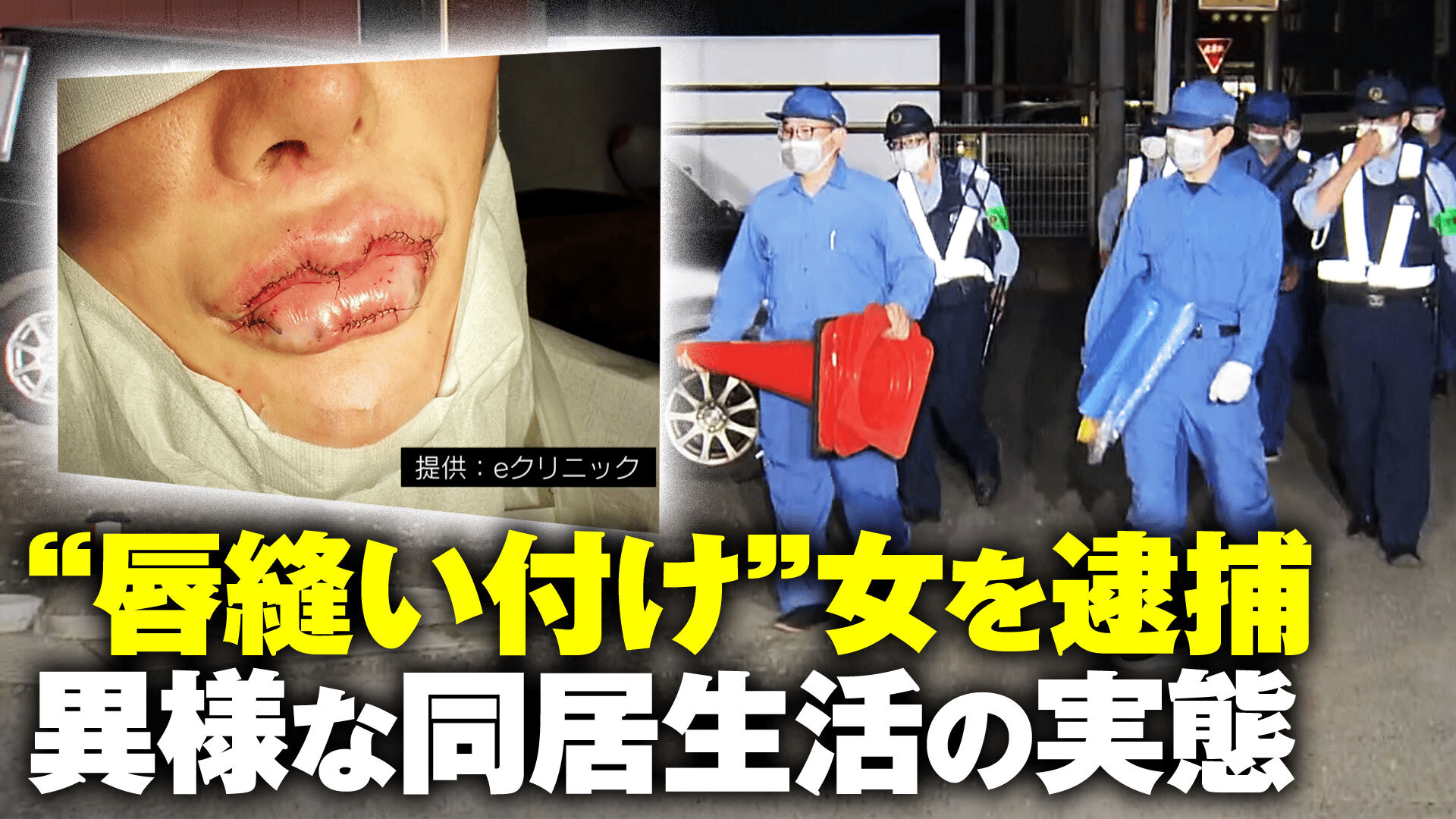 唇 縫う ニュース